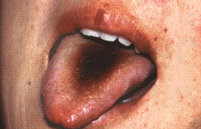 (Abb. 5) Leicht geschwollener, blasser Zungenkörper mit Zahnabdrücken; dicker gelbschwarzer Belag (Ursache hier: Medikamenteneinnahme). Diagnose: Feuchtigkeitsretention im Körper aufgrund leichten Milz-Yang-Mangels (s. Quellenverzeichnis -  © Urban & Fischer)